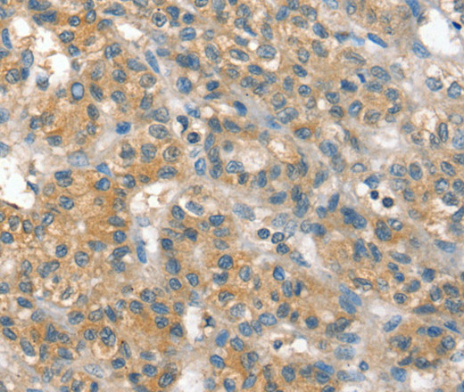 Immunohistochemistry of paraffin-embedded Human liver cancer using PPP2CA Polyclonal Antibody at dilution of 1:35