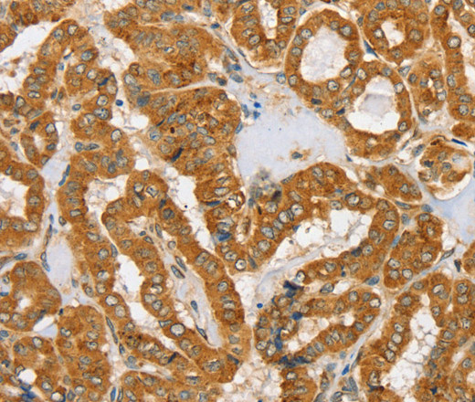 Immunohistochemistry of paraffin-embedded Human thyroid cancer tissue using PDP1 Polyclonal Antibody at dilution 1:30