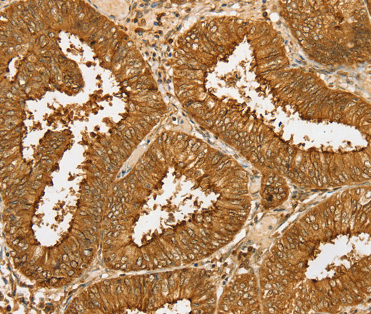 Immunohistochemistry of paraffin-embedded Human cervical cancer tissue using PDP1 Polyclonal Antibody at dilution 1:30