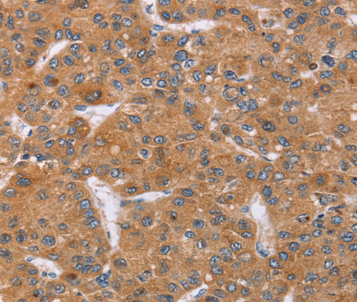 Immunohistochemistry of paraffin-embedded Human liver cancer tissue using PPP2R3C Polyclonal Antibody at dilution 1:30