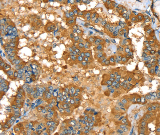 Immunohistochemistry of paraffin-embedded Human thyroid cancer using PYGL Polyclonal Antibody at dilution of 1:35