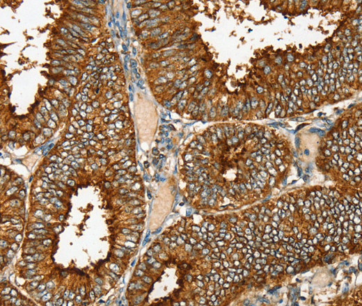 Immunohistochemistry of paraffin-embedded Human cervical cancer tissue using RAB25 Polyclonal Antibody at dilution 1:35