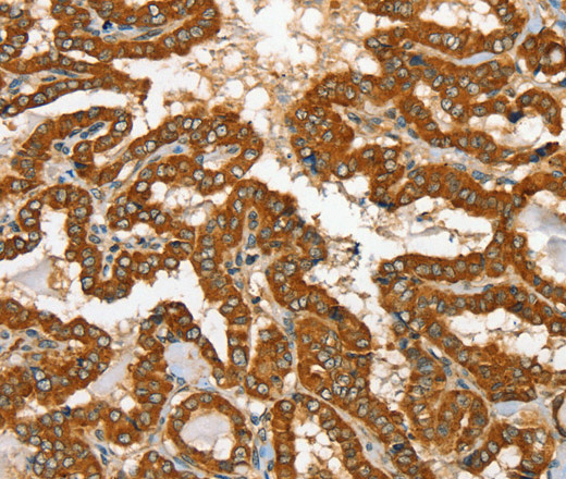 Immunohistochemistry of paraffin-embedded Human thyroid cancer tissue using RAB25 Polyclonal Antibody at dilution 1:35