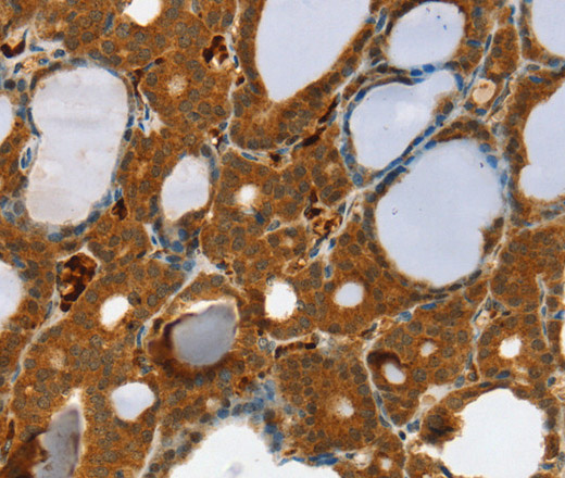 Immunohistochemistry of paraffin-embedded Human thyroid cancer using RAB27A Polyclonal Antibody at dilution of 1:30