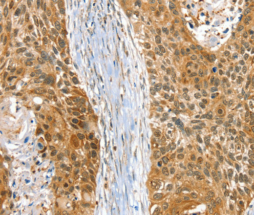 Immunohistochemistry of paraffin-embedded Human esophagus cancer using RAB27A Polyclonal Antibody at dilution of 1:30