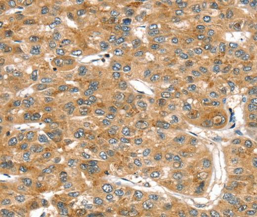 Immunohistochemistry of paraffin-embedded Human liver cancer tissue using RASSF9 Polyclonal Antibody at dilution 1:45