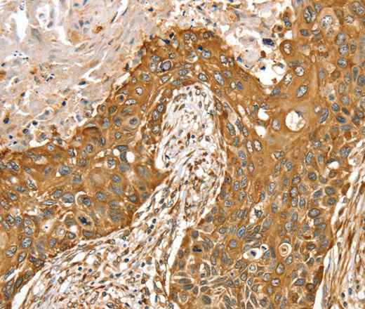 Immunohistochemistry of paraffin-embedded Human esophagus cancer tissue using RASSF9 Polyclonal Antibody at dilution 1:45