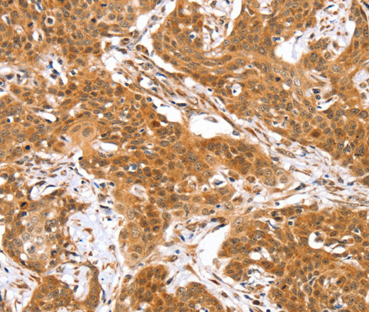 Immunohistochemistry of paraffin-embedded Human cervical cancer using RGS22 Polyclonal Antibody at dilution of 1:40