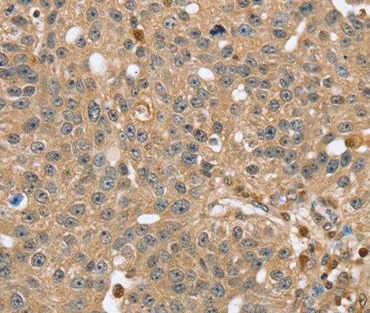 Immunohistochemistry of paraffin-embedded Human breast cancer using RNH1 Polyclonal Antibody at dilution of 1:40