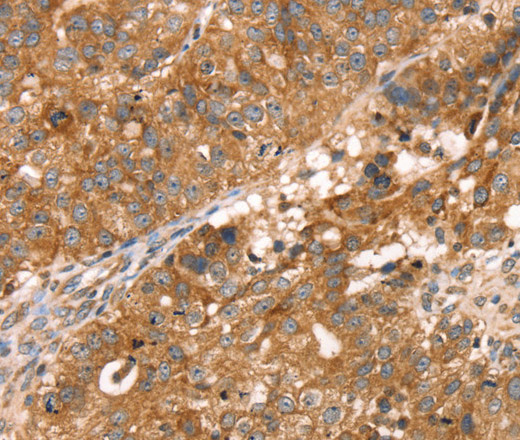 Immunohistochemistry of paraffin-embedded Human breast cancer using PDLIM4 Polyclonal Antibody at dilution of 1:30