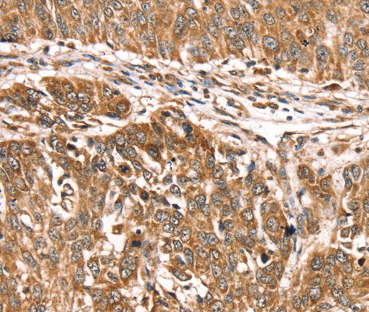 Immunohistochemistry of paraffin-embedded Human lung cancer using PDLIM4 Polyclonal Antibody at dilution of 1:30