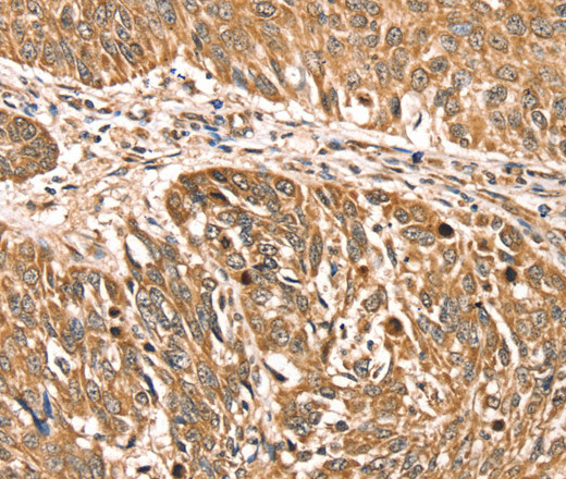 Immunohistochemistry of paraffin-embedded Human lung cancer using RPLP2 Polyclonal Antibody at dilution of 1:35