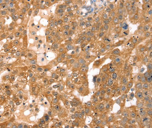 Immunohistochemistry of paraffin-embedded Human breast cancer using RPS6KA1 Polyclonal Antibody at dilution of 1:30