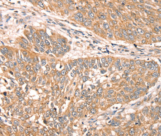 Immunohistochemistry of paraffin-embedded Human lung cancer using RPS6KA1 Polyclonal Antibody at dilution of 1:30