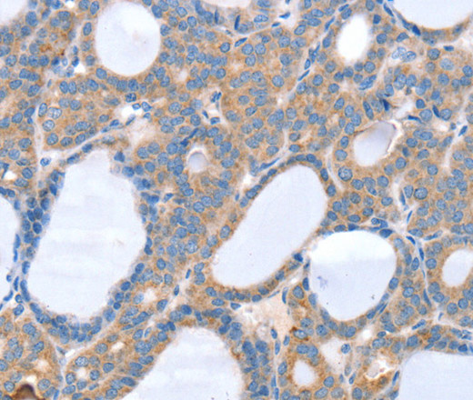 Immunohistochemistry of paraffin-embedded Human thyroid cancer using SLC25A13 Polyclonal Antibody at dilution of 1:35