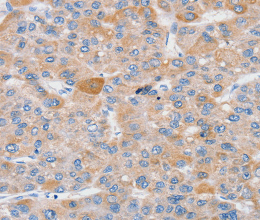 Immunohistochemistry of paraffin-embedded Human liver cancer using SLC25A13 Polyclonal Antibody at dilution of 1:35