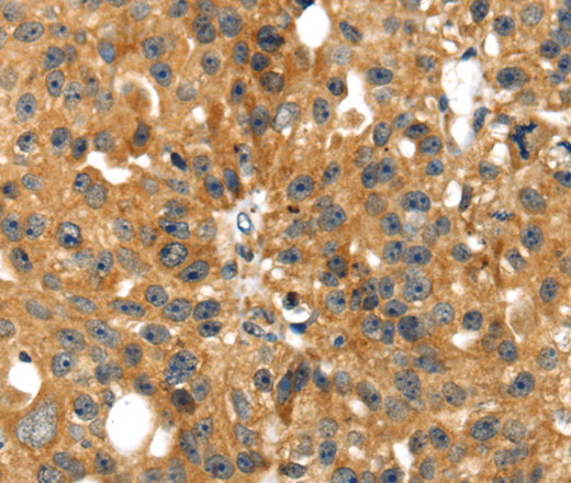 Immunohistochemistry of paraffin-embedded Human breast cancer tissue using SMYD4 Polyclonal Antibody at dilution 1:40