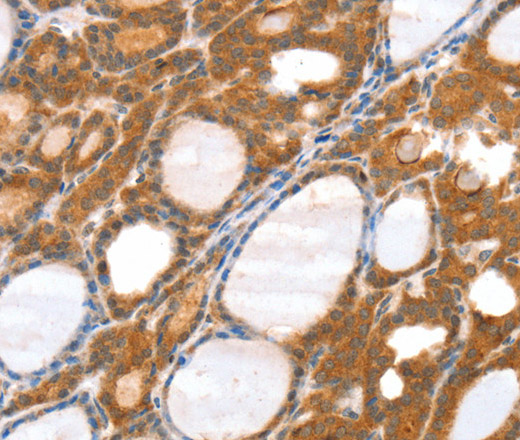 Immunohistochemistry of paraffin-embedded Human thyroid cancer tissue using SRGAP3 Polyclonal Antibody at dilution 1:40