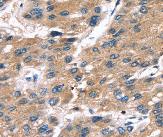 Immunohistochemistry of paraffin-embedded Human liver cancer tissue using SRGN Polyclonal Antibody at dilution 1:25