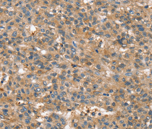 Immunohistochemistry of paraffin-embedded Human liver cancer using SSX2IP Polyclonal Antibody at dilution of 1:45