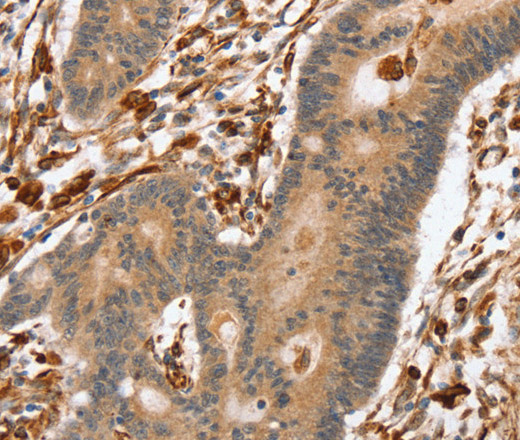 Immunohistochemistry of paraffin-embedded Human colon cancer using SSX2IP Polyclonal Antibody at dilution of 1:45