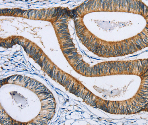 Immunohistochemistry of paraffin-embedded Human colon cancer using SULT1B1 Polyclonal Antibody at dilution of 1:30