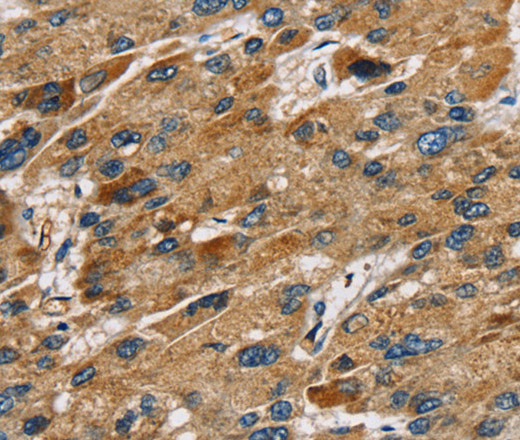 Immunohistochemistry of paraffin-embedded Human liver cancer using SULT1B1 Polyclonal Antibody at dilution of 1:30