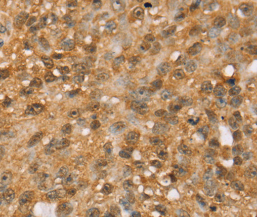 Immunohistochemistry of paraffin-embedded Human breast cancer tissue using MED22 Polyclonal Antibody at dilution 1:50