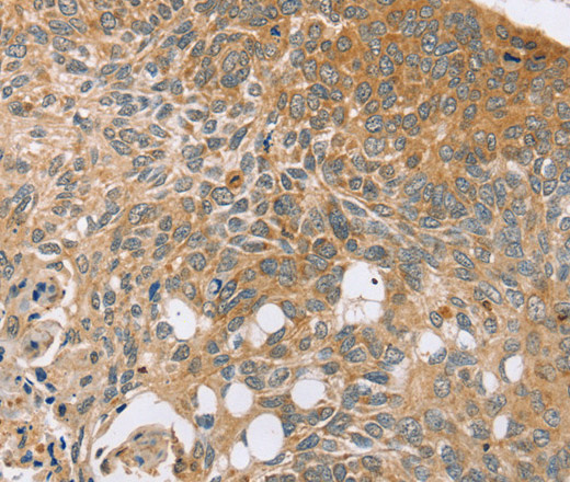 Immunohistochemistry of paraffin-embedded Human esophagus cancer tissue using SYTL5 Polyclonal Antibody at dilution 1:50