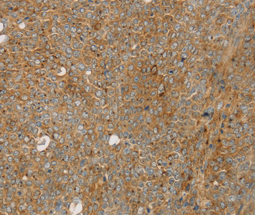 Immunohistochemistry of paraffin-embedded Human ovarian cancer using STX16 Polyclonal Antibody at dilution of 1:30