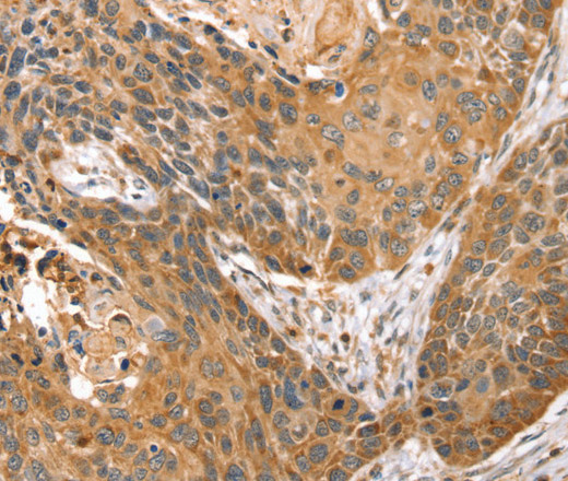 Immunohistochemistry of paraffin-embedded Human esophagus cancer using STX10 Polyclonal Antibody at dilution of 1:45