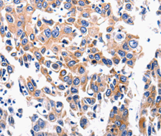 Immunohistochemistry of paraffin-embedded Human lung cancer tissue using ACE2 Polyclonal Antibody at dilution 1:200