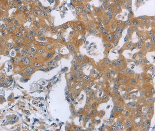 Immunohistochemistry of paraffin-embedded Human breast cancer using TNK2 Polyclonal Antibody at dilution of 1:70