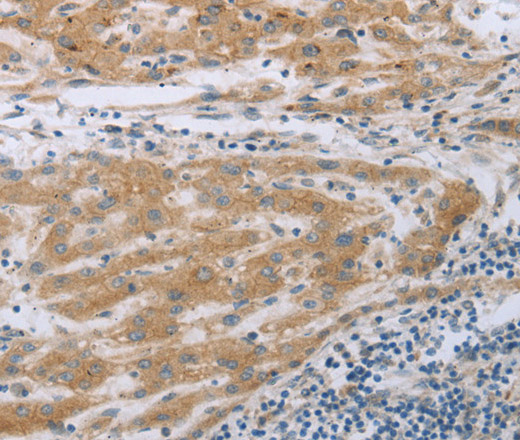 Immunohistochemistry of paraffin-embedded Human liver cancer using TNK2 Polyclonal Antibody at dilution of 1:70