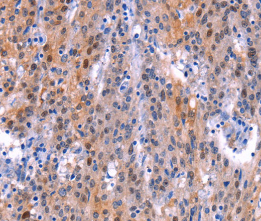 Immunohistochemistry of paraffin-embedded Human gastric cancer tissue using ADM2 Polyclonal Antibody at dilution 1:40