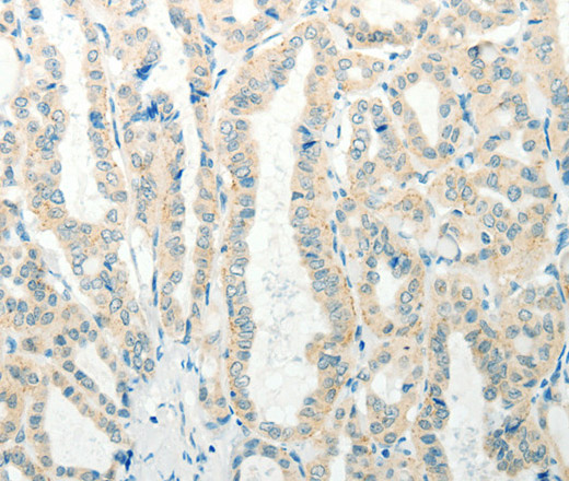 Immunohistochemistry of paraffin-embedded Human thyroid cancer tissue using RAB25 Polyclonal Antibody at dilution 1:50