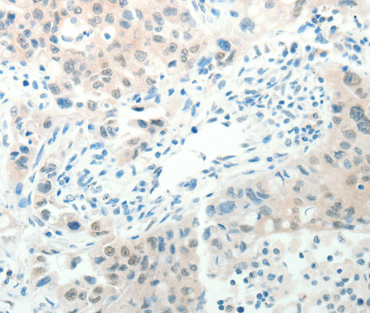 Immunohistochemistry of paraffin-embedded Human lung cancer tissue using RAB25 Polyclonal Antibody at dilution 1:50