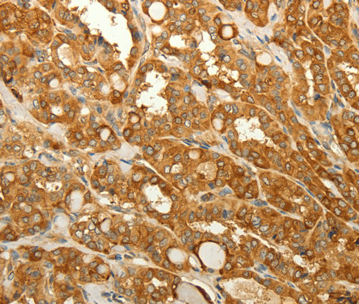 Immunohistochemistry of paraffin-embedded Human thyroid cancer tissue using RAB35 Polyclonal Antibody at dilution 1:50