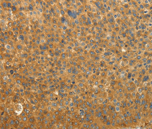 Immunohistochemistry of paraffin-embedded Human liver cancer tissue using RAB35 Polyclonal Antibody at dilution 1:50