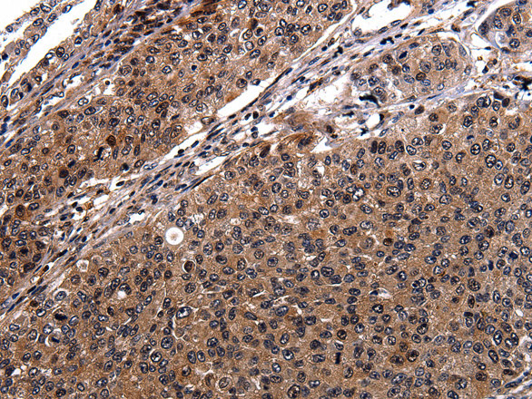 Immunohistochemistry of paraffin-embedded Human cervical cancer tissue using RAB41 Polyclonal Antibody at dilution 1:100