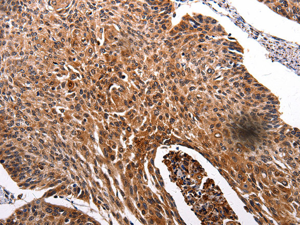 Immunohistochemistry of paraffin-embedded Human renal cancer tissue using RAB41 Polyclonal Antibody at dilution 1:100