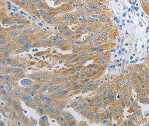 Immunohistochemistry of paraffin-embedded Human ovarian cancer tissue using RHEB Polyclonal Antibody at dilution 1:30