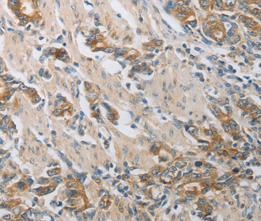 Immunohistochemistry of paraffin-embedded Human gastic cancer using CST3 Polyclonal Antibody at dilution of 1:50