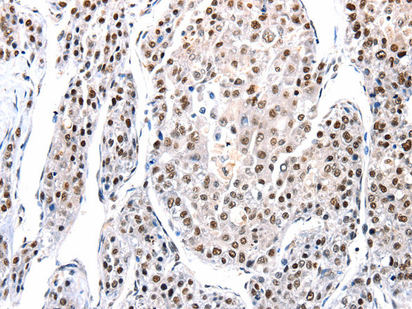 Immunohistochemistry of paraffin-embedded Human liver cancer tissue using AQP2 Polyclonal Antibody at dilution 1:100