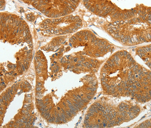 Immunohistochemistry of paraffin-embedded Human colon cancer tissue using ASCL1 Polyclonal Antibody at dilution 1:30