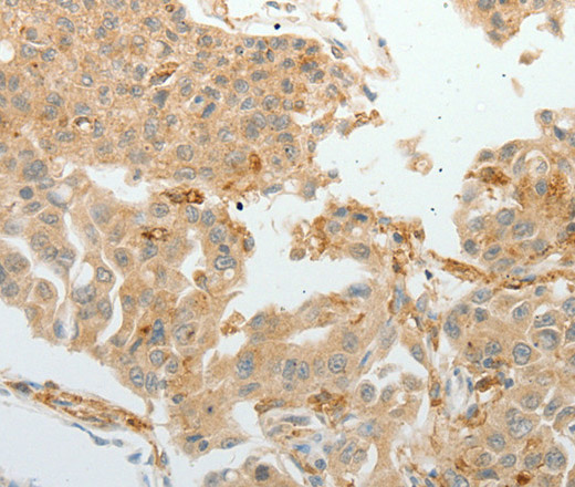 Immunohistochemistry of paraffin-embedded Human lung cancer tissue using ASCL1 Polyclonal Antibody at dilution 1:30