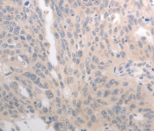 Immunohistochemistry of paraffin-embedded Human ovarian cancer tissue using CD275 Polyclonal Antibody at dilution 1:30