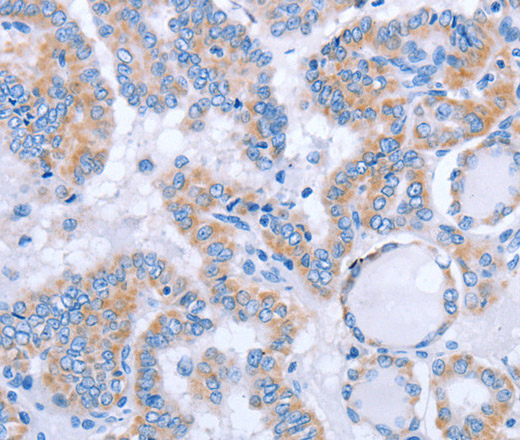 Immunohistochemistry of paraffin-embedded Human thyroid cancer tissue using FGF4 Polyclonal Antibody at dilution 1:40