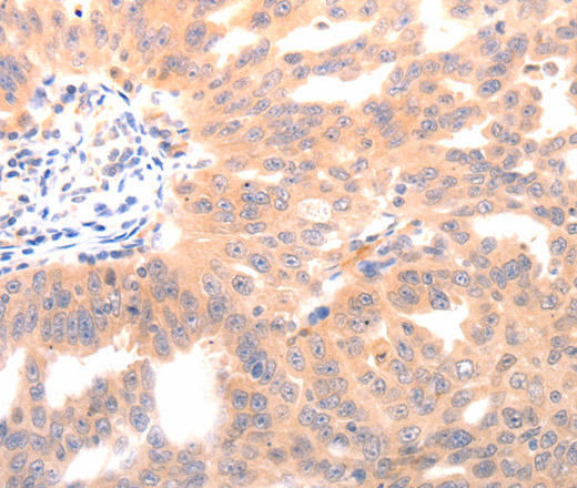 Immunohistochemistry of paraffin-embedded Human ovarian cancer using BGLAP Polyclonal Antibody at dilution of 1:40