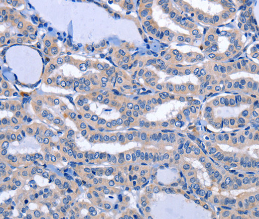 Immunohistochemistry of paraffin-embedded Human thyroid cancer tissue using NPPB Polyclonal Antibody at dilution 1:40